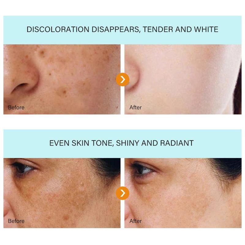 Whitening and anti-freckle cream