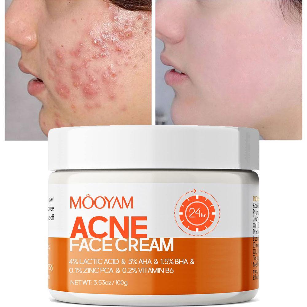 MOOYAM ACNE FACE CREAM